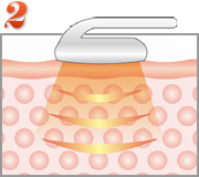 【2】脂肪細胞に効果的な周波数の超音波を照射し、振動させます。